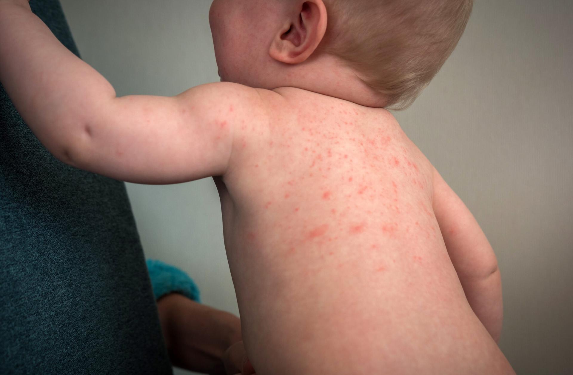 penanganan awal campak