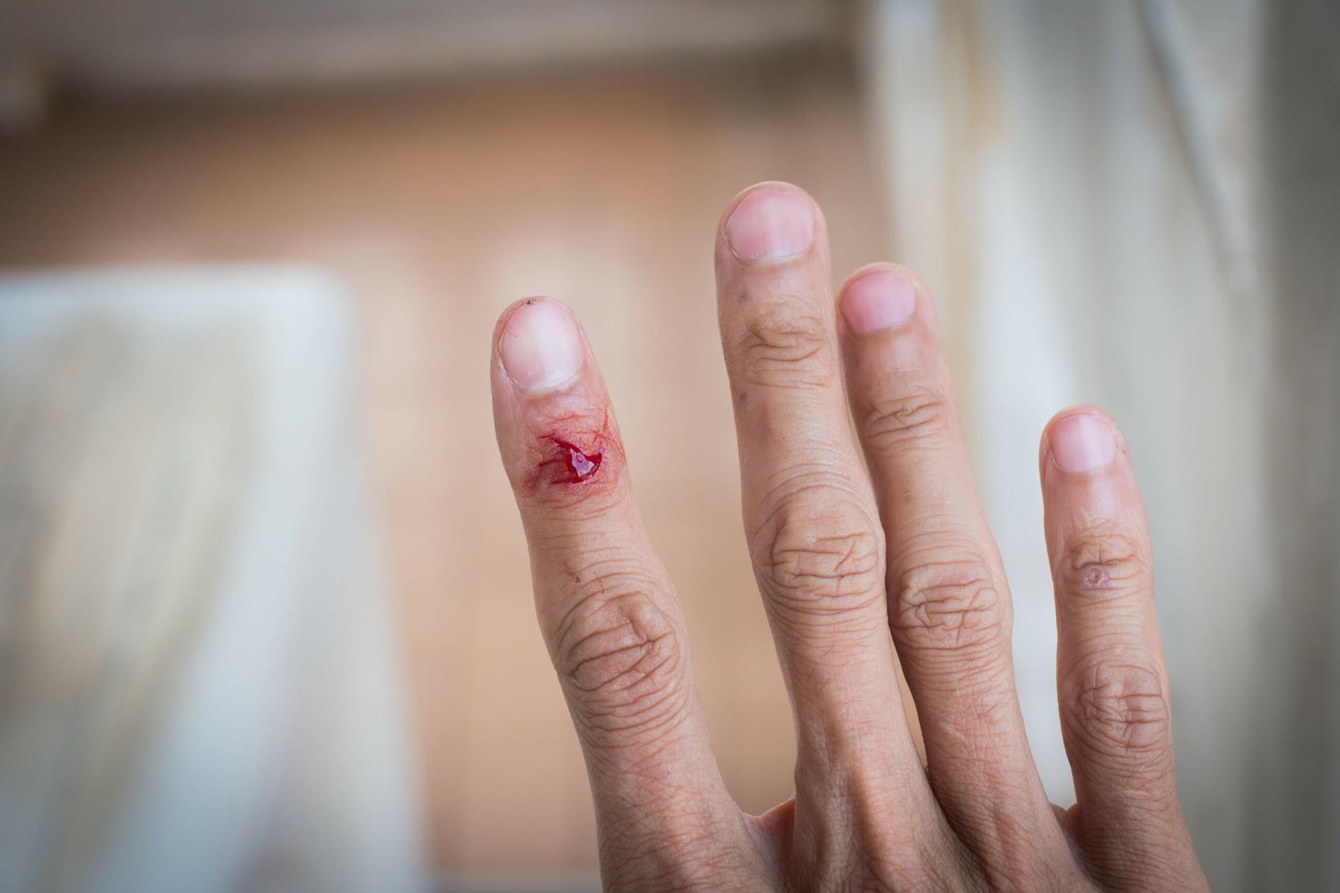 bakteri pemakan daging